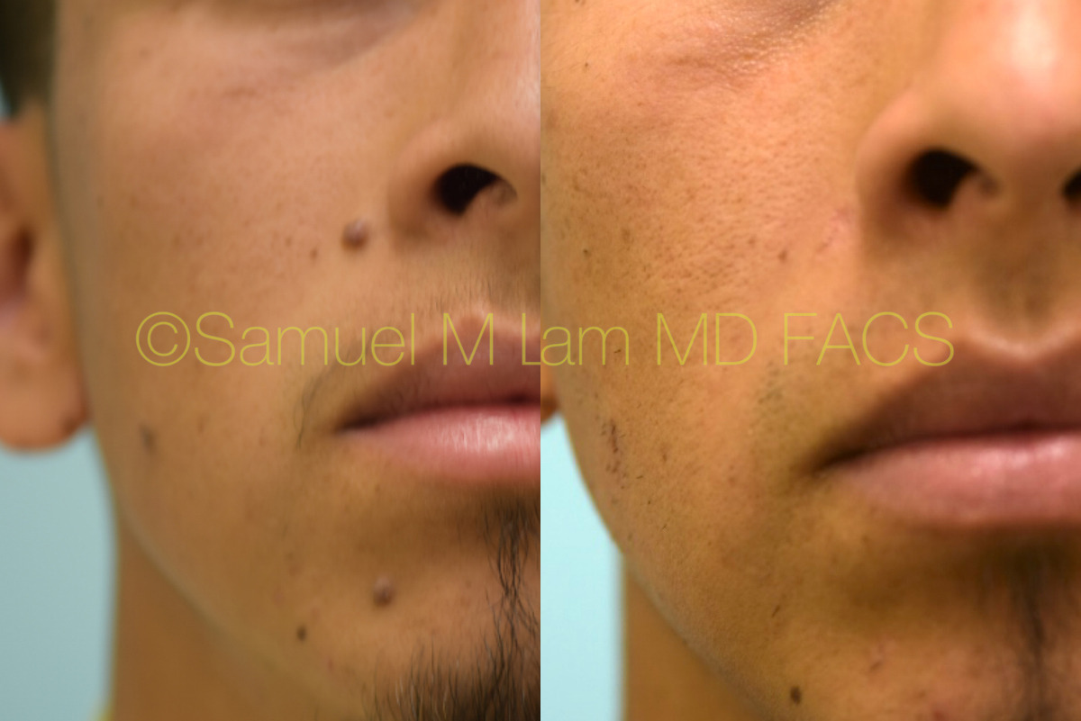 Facial Mole Removal Scarring