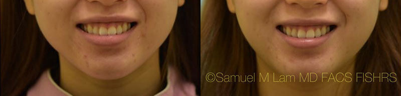 Dallas Botox Before and After Photos - Plano Plastic Surgery Photo Gallery  - Dr. Sam LamBotox Archives