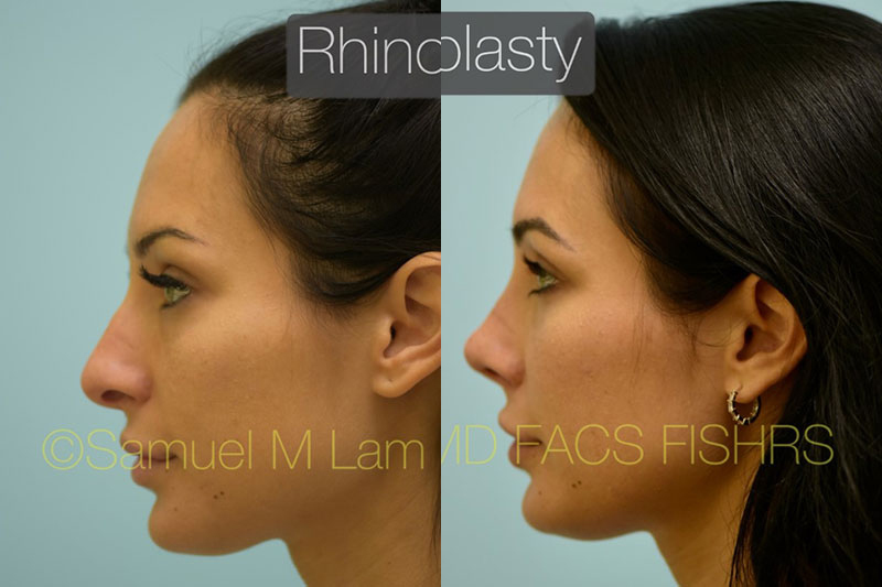 Nasal Tip Rhinoplasty Result Dallas