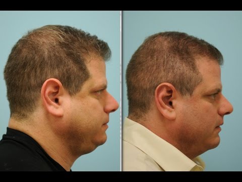 Rhinoplasty-Otoplasty-Chin Implant-Neck Lipo-FUE Hair Transplant Testimonial in Dallas