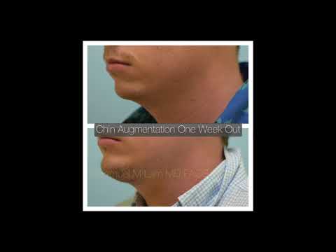 Dallas Chin Augmentation Testimonial One Week Out