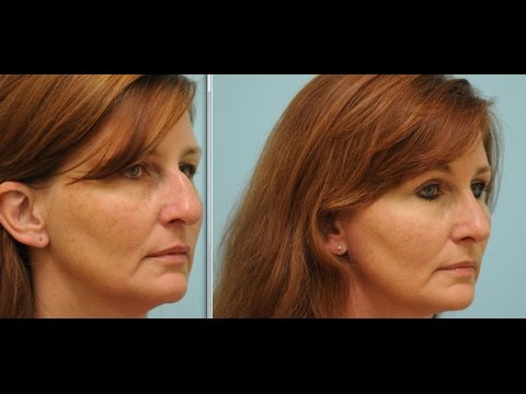 Cosmetic and Functional Rhinoplasty (Nose Job) Testimonial in Dallas, Texas with Dr. Lam
