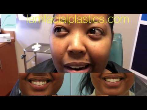 Botox Gummy Smile Testimonial in Dallas, Texas