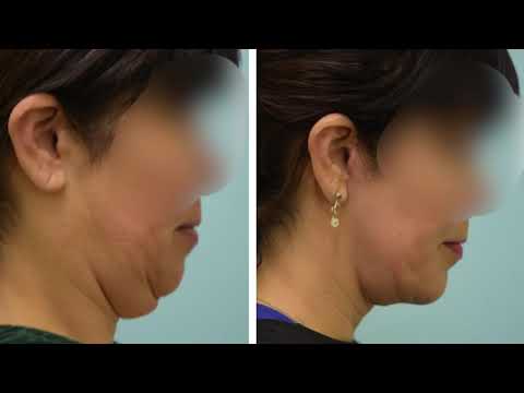 Dallas Facelift Audio Testimonial with Photos