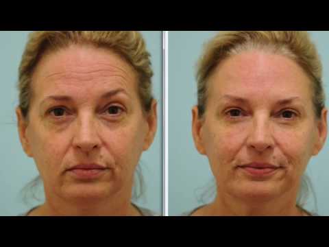 Botox and Fillers First Time Testimonial
