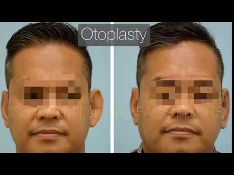Dallas Otoplasty of the Left Ear One Day Out