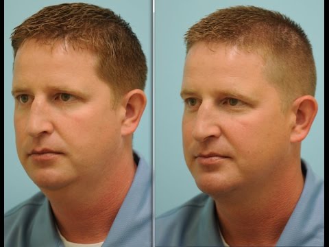 Jordan's Chin Implant and Neck Liposuction Testimonial in Dallas, Texas