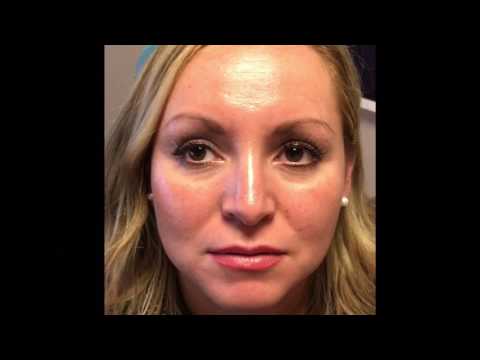 Mole Removal Close Up & Testimonial in Dallas, TX
