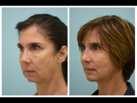 Dallas Deep-Plane Facelift & Extended Large Chin Implant 2 Years Out Testimonial with Photos