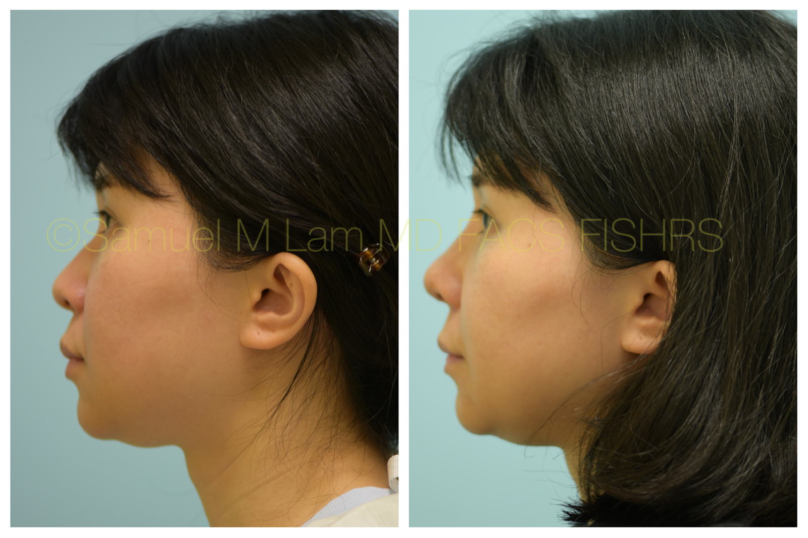 Nasal Tip Rhinoplasty Result Dallas