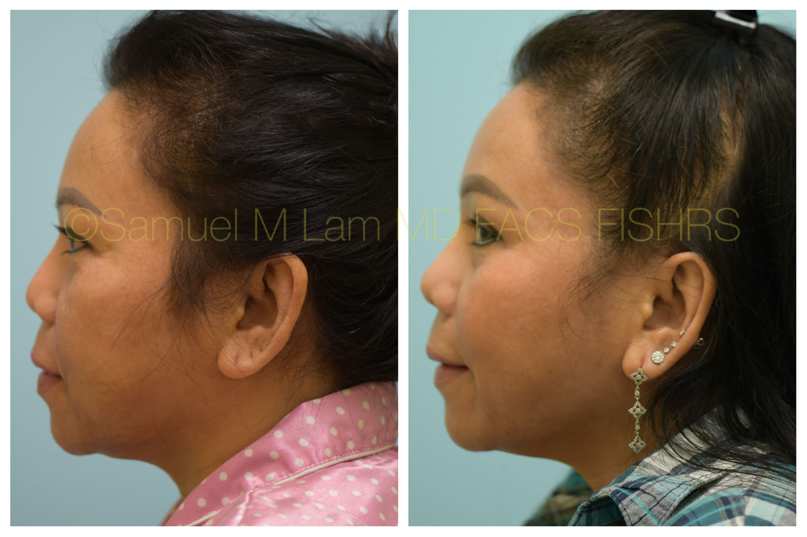 Nasal Tip Rhinoplasty Result Dallas