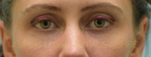 Eyelid Rejuvenation Case 30685 After Photo Eyelid Rejuvenation