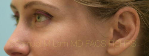 Eyelid Rejuvenation Case 30689 After Photo Eyelid Rejuvenation