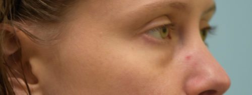 Eyelid Rejuvenation Case 30686 Before Photo Eyelid Rejuvenation