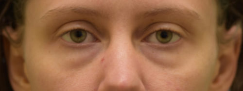 Eyelid Rejuvenation Case 30684 Before Photo Eyelid Rejuvenation