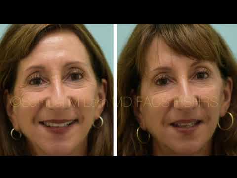 Dallas Botox Testimonial Before and After Photos