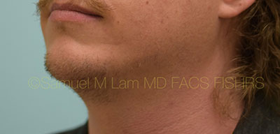 Chin Augmentation Case 30938 After Photo Chin Augmentation