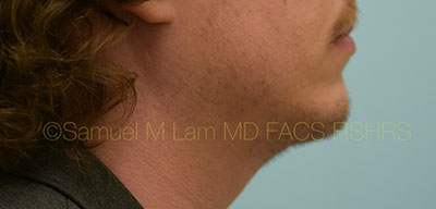 Chin Augmentation Case 30936 After Photo Chin Augmentation