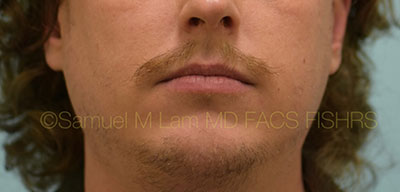 Chin Augmentation Case 30930 After Photo Chin Augmentation