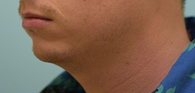 Chin Augmentation Case 30935 Before Photo Chin Augmentation