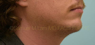 Chin Augmentation Case 30934 After Photo Chin Augmentation