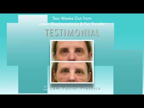 Dallas Fat Graft and Lower Blepharoplasty/ Eyelid Surgery Audio Testimonial with Photos
