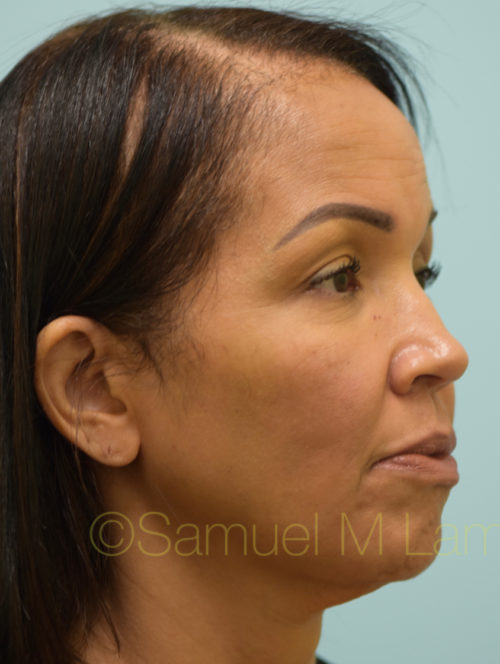 Facelift/Neck Lift Case 32101 Before Photo Facelift/Neck Lift