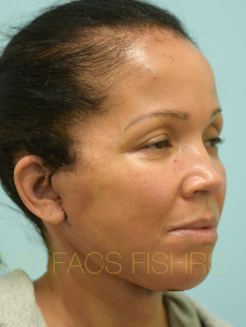 Facelift/Neck Lift Case 32102 After Photo Facelift/Neck Lift