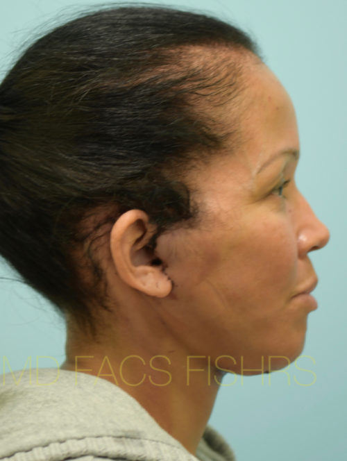 Facelift/Neck Lift Case 32100 After Photo Facelift/Neck Lift