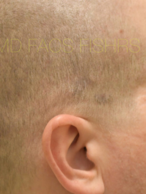 Scar Revision Case 32219 After Photo Scar Revision
