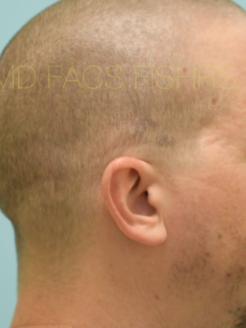 Scar Revision Case 32215 After Photo Scar Revision