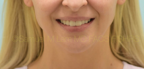 Botox Jaw Reduction