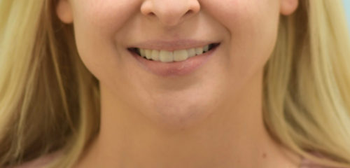Botox Jaw Reduction