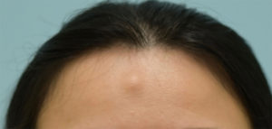 Osteoma Patient of Dr. Lam, Before Procedure