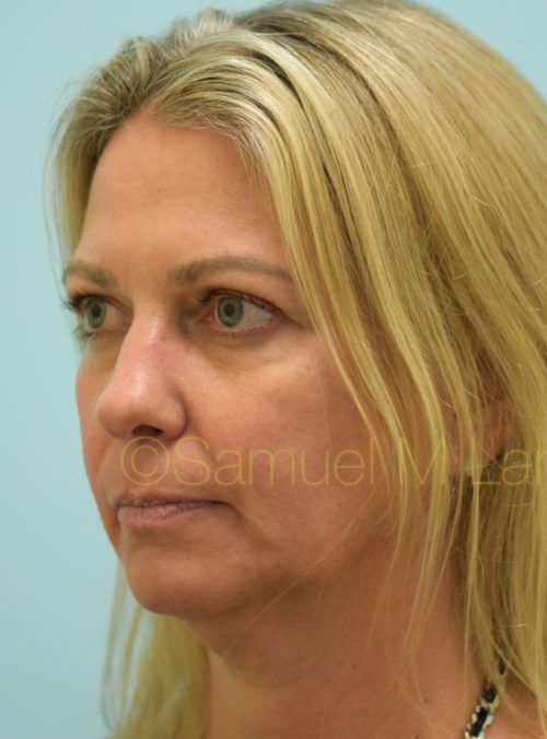 Botox Case 32888 Before Photo Botox
