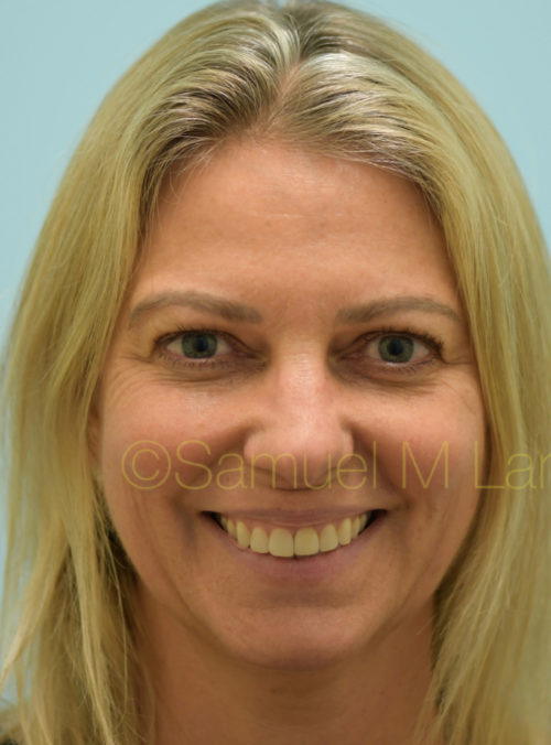 Botox Case 32882 Before Photo Botox