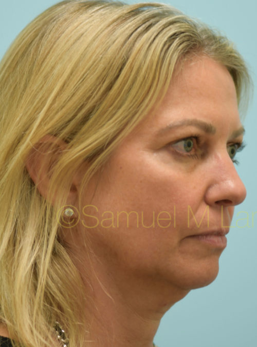 Botox Case 32884 Before Photo Botox