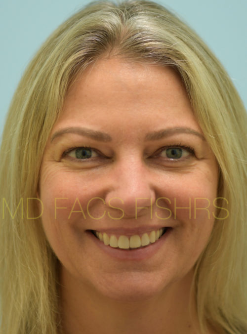Botox Case 32883 After Photo Botox
