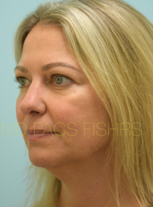 Botox Case 32889 After Photo Botox