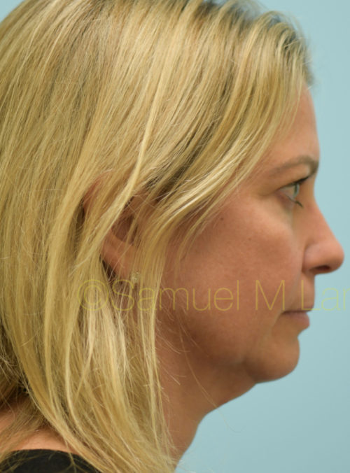 Botox Case 32886 Before Photo Botox