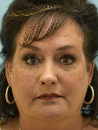 Fat Grafting Case 32928 After Photo Fat Grafting