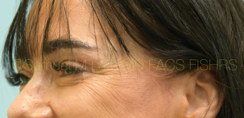 Eyelid Rejuvenation Case 32957 After Photo Eyelid Rejuvenation