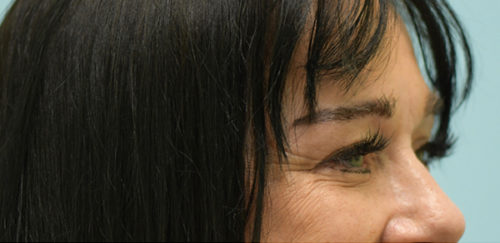 Eyelid Rejuvenation Case 32954 Before Photo Eyelid Rejuvenation