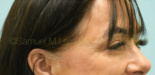 Eyelid Rejuvenation Case 32955 After Photo Eyelid Rejuvenation