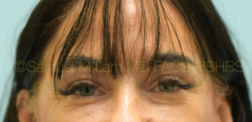 Eyelid Rejuvenation Case 32953 After Photo Eyelid Rejuvenation