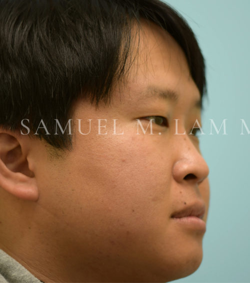 Rhinoplasty-Nose Job Case 37124 Before Photo Rhinoplasty-Nose Job