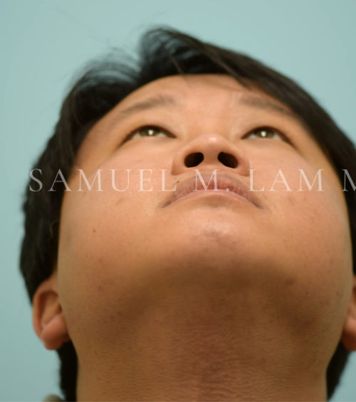 Rhinoplasty-Nose Job Case 37128 Before Photo Rhinoplasty-Nose Job