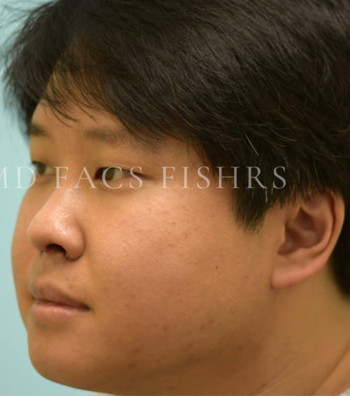 Rhinoplasty-Nose Job Case 37127 After Photo Rhinoplasty-Nose Job