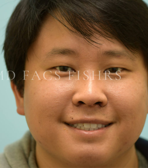Rhinoplasty-Nose Job Case 37123 After Photo Rhinoplasty-Nose Job