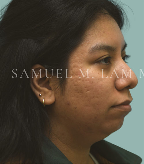 Rhinoplasty-Nose Job Case 38525 Before Photo Rhinoplasty-Nose Job